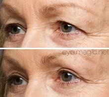 Eye Magic Original Eye Lift Kit (Small/Medium Size With Gel) Lifts Eyelid Droop and Hooded Eyes | Open And Show Off Your Beautiful Eyes | Made In America-Velvo Beauty