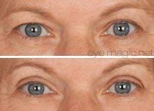 Eye Magic Original Eye Lift Kit (Small/Medium Size With Gel) Lifts Eyelid Droop and Hooded Eyes | Open And Show Off Your Beautiful Eyes | Made In America-Velvo Beauty