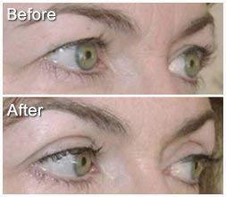 Eye Magic Original Eye Lift Kit (Small/Medium Size With Gel) Lifts Eyelid Droop and Hooded Eyes | Open And Show Off Your Beautiful Eyes | Made In America-Velvo Beauty