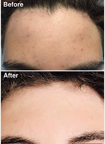 Teenology Shampoo for Teens - Avoid Forehead and Body Acne - No Sulfates or Parabens, Noncomedogenic, Natural Botanical Extracts, 16 oz. (Sweet Mint)-Velvo Beauty
