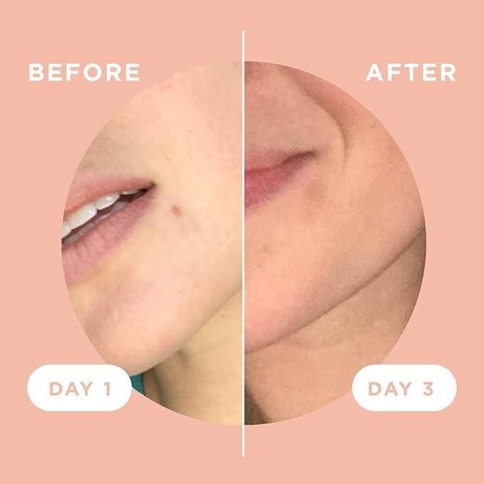 ZitSticka Killa Acne Patches for Face - World's Most Potent Pimple Patch with Fast-Acting Microdarts - Starts Working within 2 Hours for Deep, Early-Stage Zits & Blemish - 4 Count-Velvo Beauty