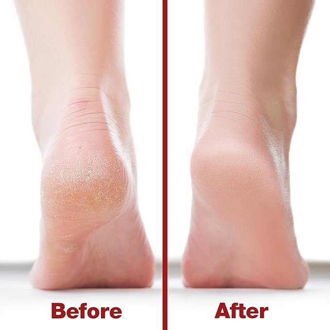 Probelle Double Sided Multidirectional Nickel Foot File Callus Remover - Immediately Reduces calluses and Corns to Powder for Instant Results, Safe Tool (Red)-Velvo Beauty