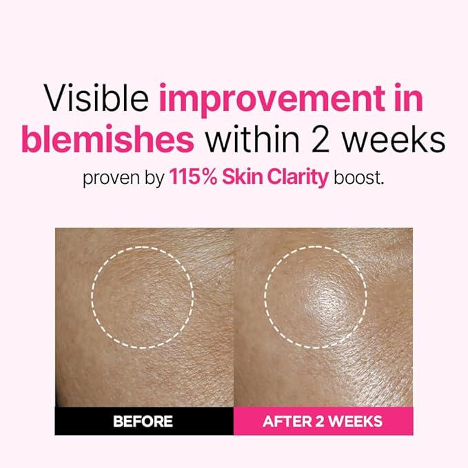 ISOI Blemish Care Up Serum for Face, Vegan Hydrating Serum for Smooth & Glass Skin Effect, Skin Barrier & Moisture Balance for Women, Korean Skin Care (0.85 fl. oz, 25ml)-Velvo Beauty