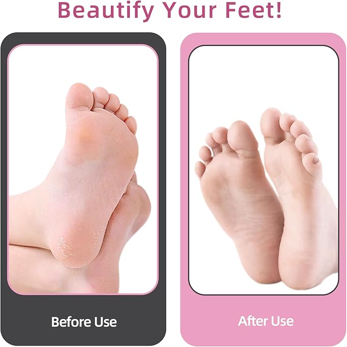 4.8IN Longer Electric Foot Callus Remover with 80pcs Sandpaper Discs, Professional Aluminum Callus Remover for Feet, Stepless Speed Control Pedicure Tools for Dead Skin (Black)-Velvo Beauty