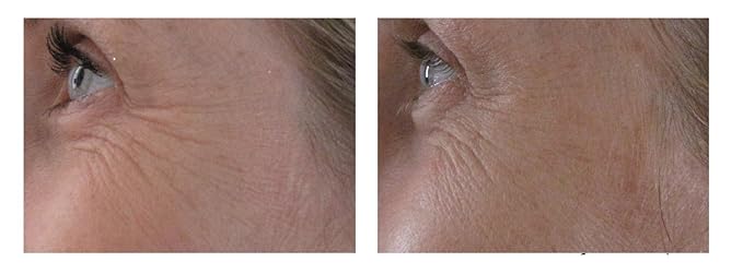Airelle Age-Defying Eye and Lip Treatment | Anti Aging, Helps Reduce Wrinkles, Fine Lines | Dermatologist Recommended | Hyaluronic Acid, Berrimatrix | Natural Ingredients | .3 Fl Oz-Velvo Beauty