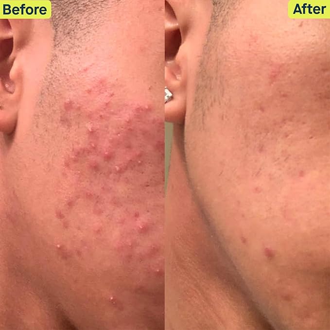 SLMD Skincare by Dr. Pimple Popper - 30-Day Acne System - 4-pc Kit - 3 Steps, 2x per Day Full Routine to Treat and Prevent All Stages of Acne-Velvo Beauty