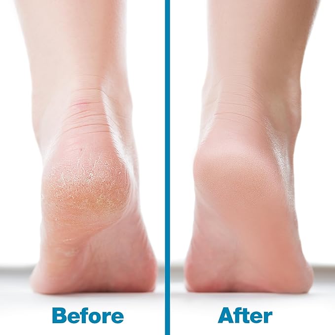 Probelle Double Sided Multidirectional Nickel Foot File Callus Remover - Immediately Reduces calluses and Corns to Powder for Instant Results, Safe Tool (Blue)-Velvo Beauty