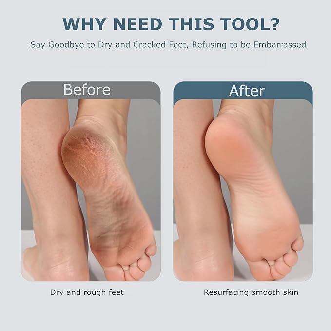 Upgraded Electric Foot Callues Remover, Portable Electric Foot Files with 3 Heads, Rechargeable Feet File for Foot Care, Waterproof Deadskin Remover, Pedicure Tool for Dry and Crack Feet-Velvo Beauty