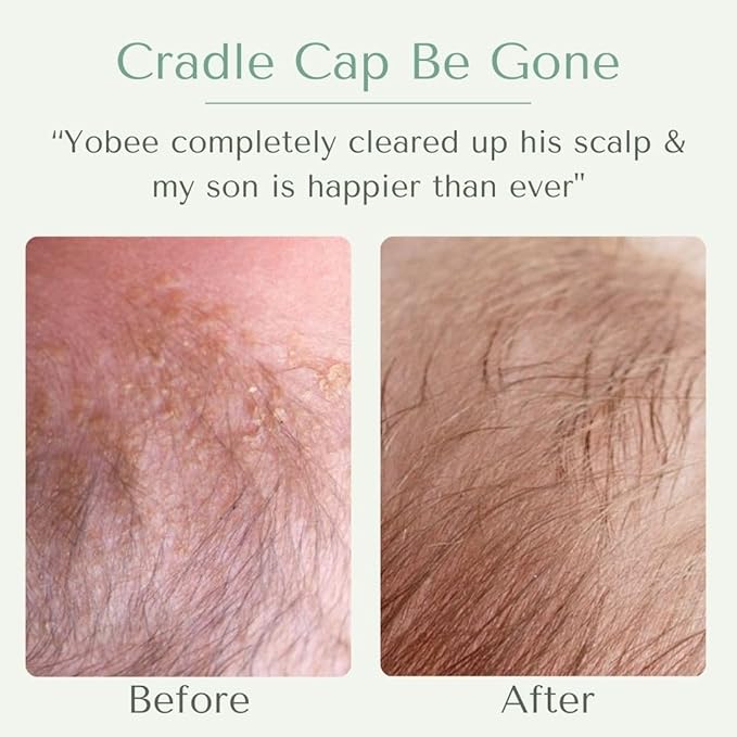 Yobee Ultra Gentle Soothing Scalp Mask - Dry Scalp Treatment Hair Mask Safe For Sensitive Baby Skin - Probiotic Infused - For Sensitive Scalp & Cradle Cap - For Babies, 4 fl oz-Velvo Beauty