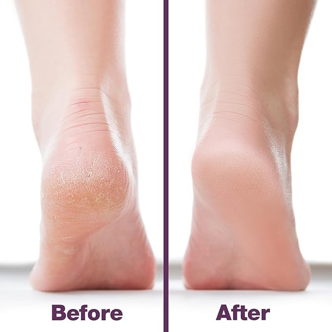 Probelle Double Sided Multidirectional Nickel Foot File Callus Remover - Immediately Reduces calluses and Corns to Powder for Instant Results, Safe Tool (Purple)-Velvo Beauty