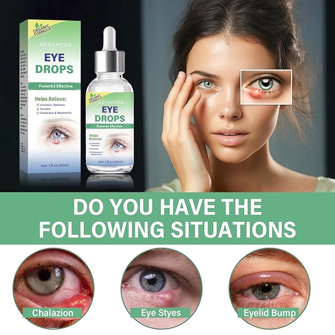 Stye Eye Treatment, Stye Eye Drops Serum for Styes Chalazion and Blepharitis, Chalazion Remover Fast Relief, Restore Healthier Eye Skin, 30ml-Velvo Beauty