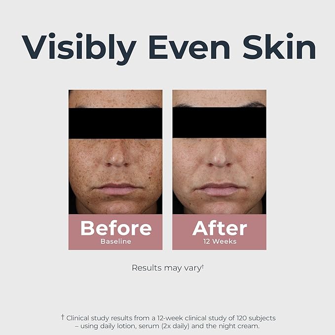 Eucerin Radiant Tone Dual Serum Dark Spot Corrector, Dark Spot Serum with Thiamidol and Hyaluronic Acid, Helps Visibly Reduce the Look of Persistent Dark Spots, 1 Fl Oz Bottle-Velvo Beauty