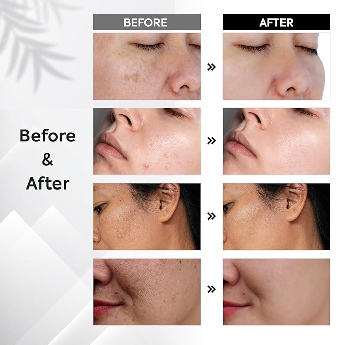 Dark Spot Remover for Face: Remove Sun & Age Spot Corrector – Melasma & Hyperpigmentation Brightening Serum for Body(Hand Leg Arm) – Brown Skin and Freckles Removal Treatment with Roller 15ml-Velvo Beauty