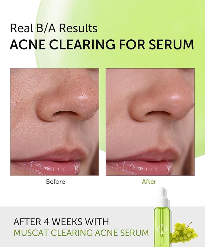 SERUMKIND Muscat Discoloration Correcting facial serum - 1fl oz - Blemishes & blackhead remover - Vegan Not Tested on Animals - Korean Skin Care - PHA Redness Relief and Exfoliating-Velvo Beauty