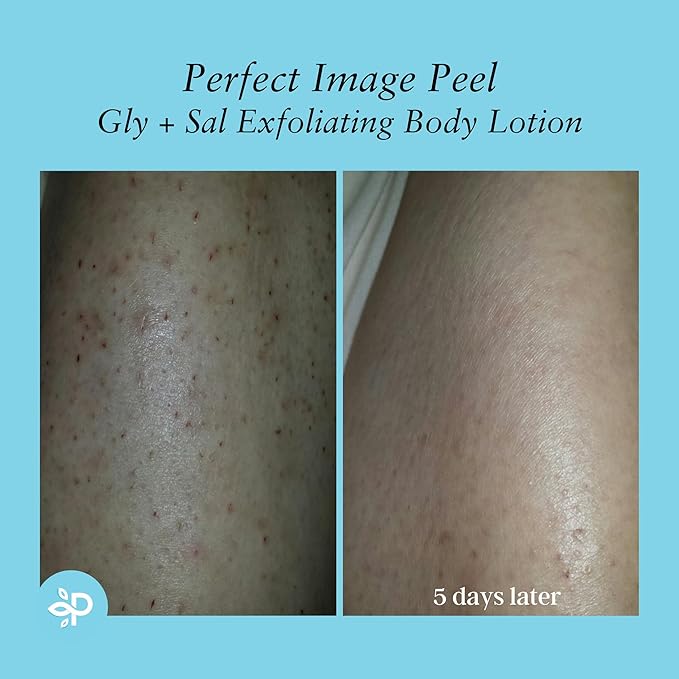 Perfect Image Gly + Sal Exfoliating Body Lotion, 8% Glycolic Acid and 2% Salicylic Acid Lotion Enhanced with Green Tea, Papaya, Bearberry, Licorice and Amino Complex-Velvo Beauty