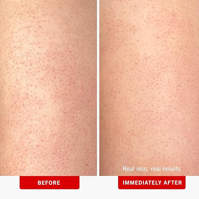 First Aid Beauty - KP Bump Eraser Body Scrub with 10% AHA, Keratosis Pilaris Exfoliator with Glycolic and Lactic acids, Helps Reduce Chicken Skin Bumps, Safe for Sensitive Skin, Strawberry Scent, 2 oz-Velvo Beauty