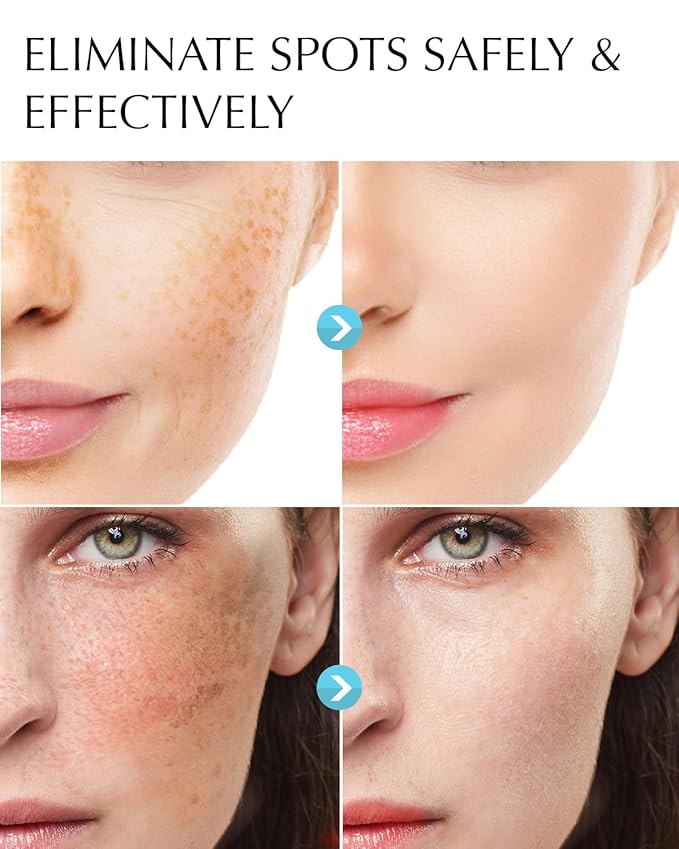 Dark Spot Remover for Face and Body: Hyperpigmentation Treatment - Natural Ingredient - Freckle/Melasma/Sun Spot/Age Spot Remover - Dark Spot Corrector Cream for Women and Men-Velvo Beauty