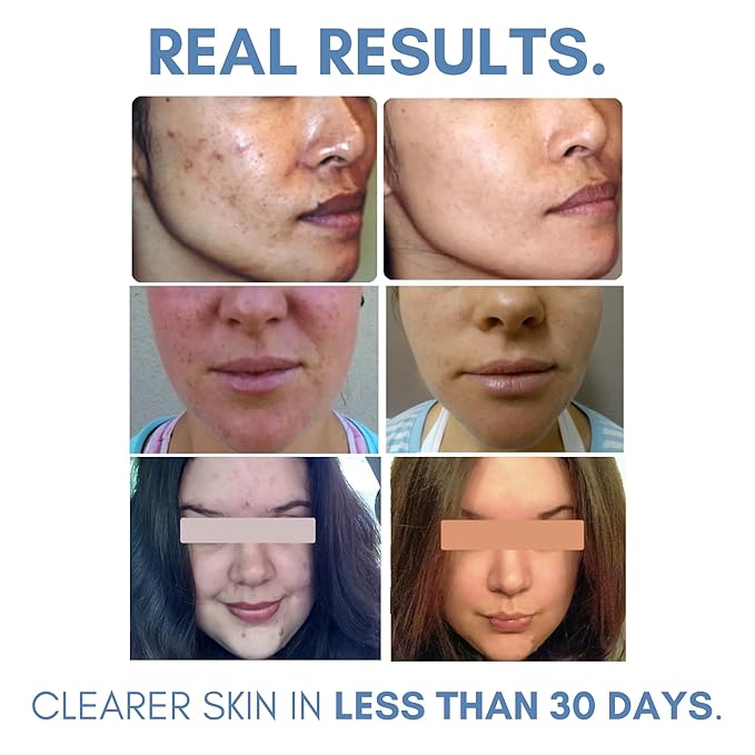Clarifying Toner for Acne and Blemishes, Face Toner, Facial Toner, Skin Toner, Acne Toner, Toner Oily Skin, Salicylic Acid Toner, Astringent for Face, Toners, 4 Fl Oz-Velvo Beauty