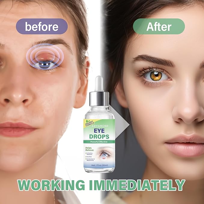 Stye Eye Treatment, Stye Eye Drops Serum for Styes Chalazion and Blepharitis, Chalazion Remover Fast Relief, Restore Healthier Eye Skin, 30ml-Velvo Beauty