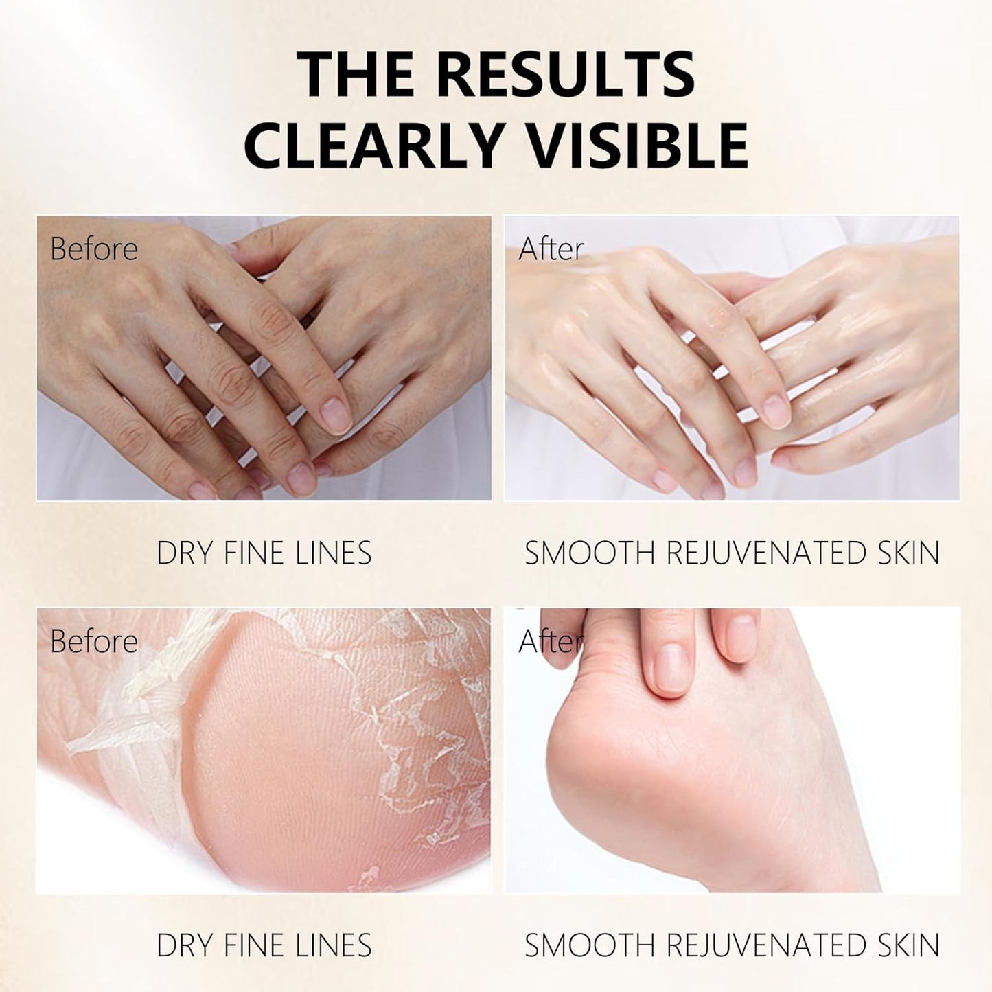 Hydrating Hand Foot Masks Set for Women Men,5 Pack Glove Mask for Dry Hand & 5 Pack Socks Mask for Dry Cracked Feet(Milk)-Velvo Beauty