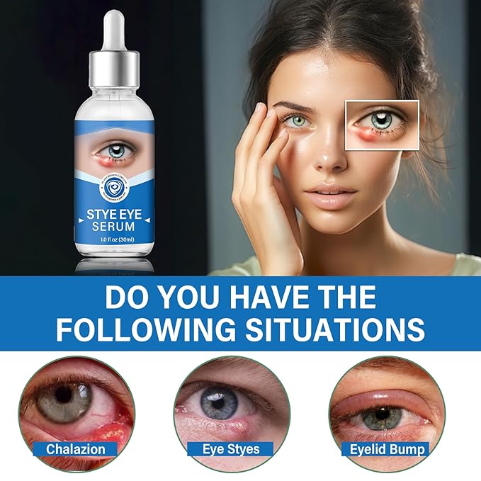 Stye Eye Treatment, Stye Eye Serum for Styes Chalazion and Blepharitis, Gently Cleanses Lashes and Eyes, Restore Healthier Eye Skin, 1 Fl.oz-Velvo Beauty