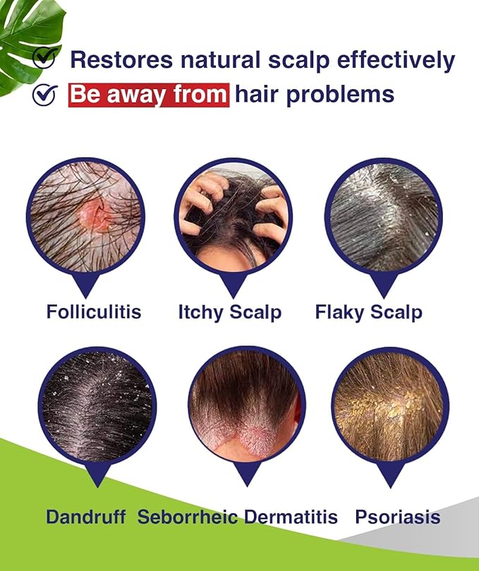 Anti-Fungal Shampoo for Folliculitis, Seborrheic Dermatitis, Scalp Psoriasis - Relieves Itchy & Dry Scalp-Velvo Beauty