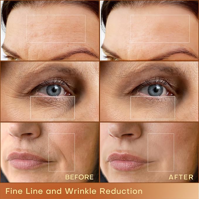 MLAY Professional RF Beauty Machine, Radio Frequency Face Machine with 2 Probes, at Home Radio Frequency Skin Tightening for Lifting, Wrinkle Reducing, Anti Aging - Salon Effects(Gel Included)-Velvo Beauty