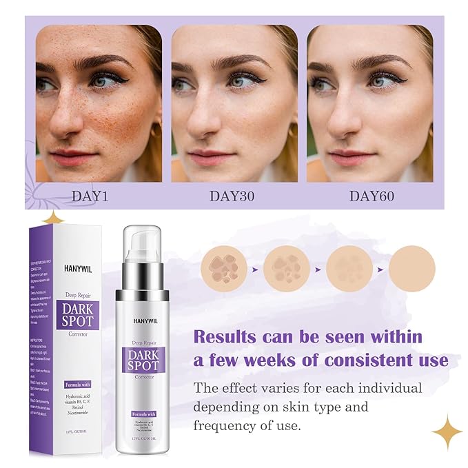 HANYWIL Dark Spot Remover for Face & Body Serum,Rapid Tone Repair Cream with Hyperpigmentation Treatment,Sun Spot, Age Spot & Melasma Remover,Dermatologist-Tested Brightening Retinol Serum (1.7 Fl Oz)-Velvo Beauty