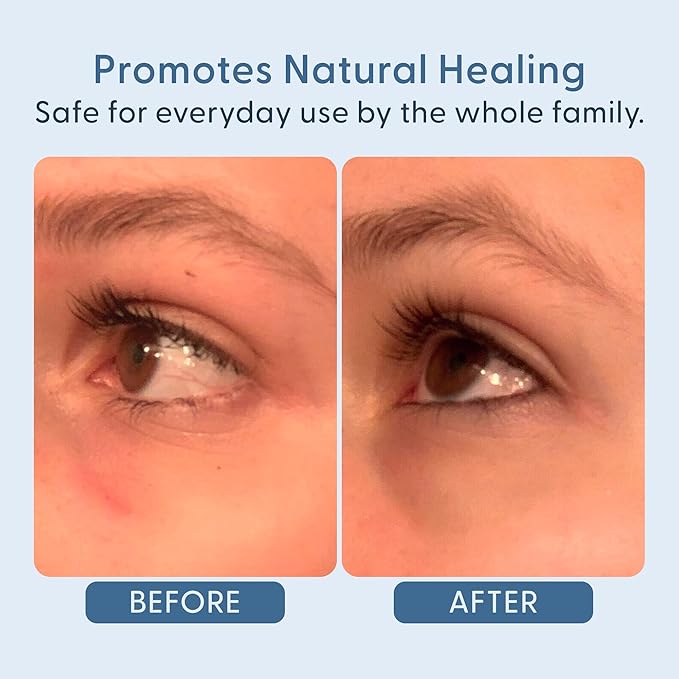 twenty/twenty Easy On The Eyes – 0.02% Hypochlorous Acid Spray to Cleanse Eyelashes – Reduce Eyelid Irritation – Safe for Sensitive Skin – Ophthalmologist Developed–Vegan, Clean Ingredients – 60ml-Velvo Beauty