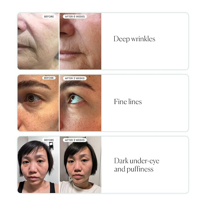 Qure Skincare MicroInfusion Targeted Patches - 8 Pairs of Targeted Under Eye Patches Formulated for Fine Lines & Wrinkles - Retinol, Caffeine, Niacinamide & Peptides - Dissolvable for Overnight Use-Velvo Beauty