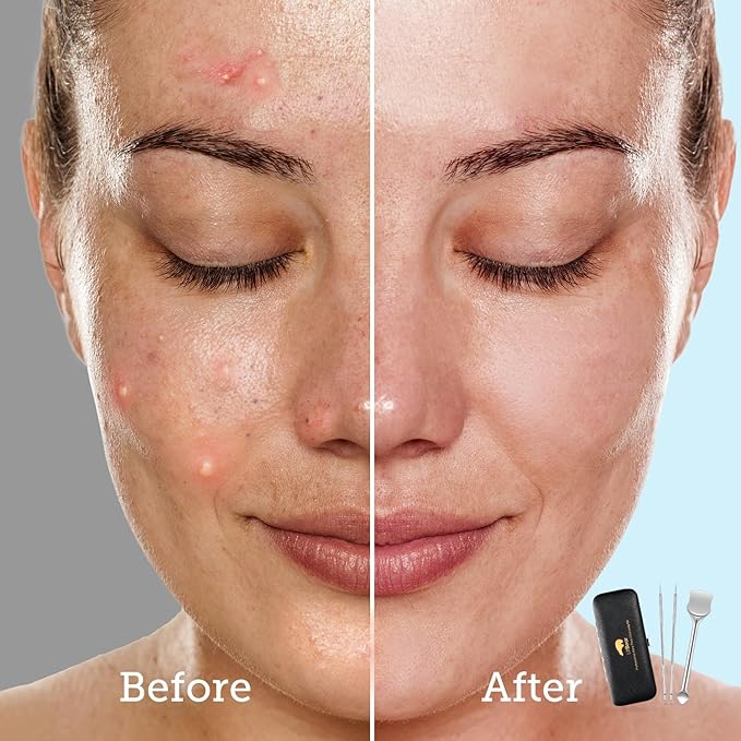 LitBear Pore Prep Tool, Blackhead Remover Pimple Popper Tool Kit, Stainless Steel Blackhead Extractions Tool for Acne, Whitehead Popping, Blemish, Comedone, Black-Velvo Beauty