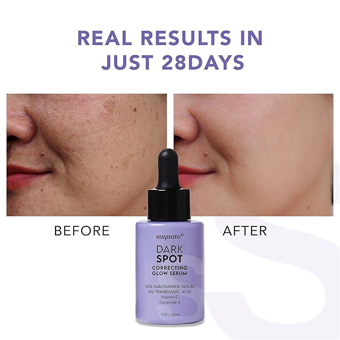 Dark Spot Correcting Glow Serum: Melasma Hyperpigmentation Treatment for Face with Tranexamic Acid Niacinamide - Vitamin C Serum and Dark Spot Remover For Face-Velvo Beauty