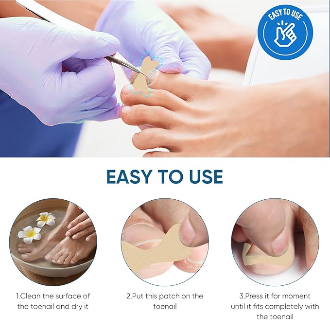 Ingrown Toenail Treatment, 60Pcs Ingrown Toenail Corrector Strips, Ingrown Toenail Removal Kit with File and Lifter, 60Pcs-Velvo Beauty