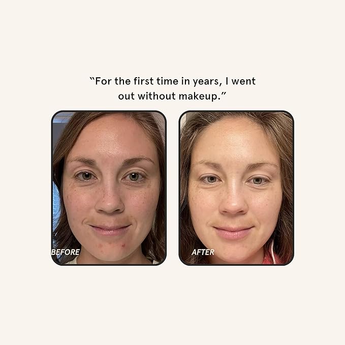 Barefaced Brightening Serum 1 Fl Oz Dark Spot Corrector with Kojic Acid, Arbutin, Azelaic Acid & Licorice, Anti-Aging, Hydrating, Fades Hyperpigmentation & Evens Skin Tone, Antioxidant-Powered Formula-Velvo Beauty