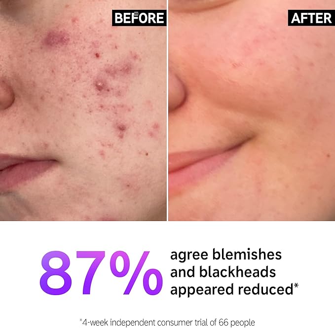 The INKEY List Salicylic Acid Cleanser, Face Wash for Blemishes, Blackheads, Oily Skin and Breakouts, Non-Drying Facial Cleanser Safe for All Skin Types, 5.0 fl oz-Velvo Beauty