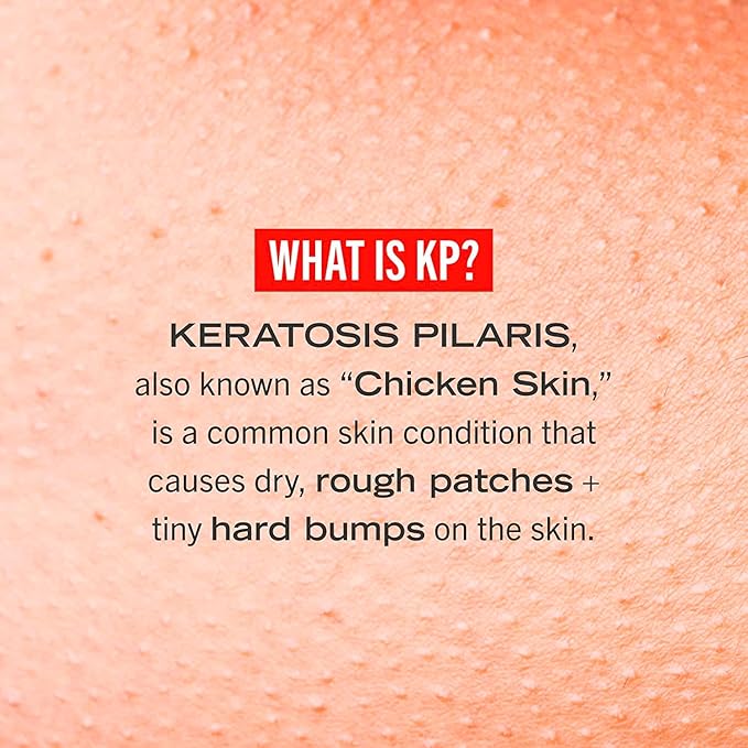 First Aid Beauty KP Bump Eraser Body Scrub Exfoliant for Keratosis Pilaris with 10% AHA – 8 oz + Bonus 1 oz Travel Size Tube-Velvo Beauty