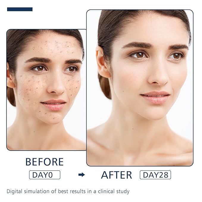 Dark Spot Remover for Face and Body - Dark Spot Advanced Corrector Serum for Melasma, Age Spots, Freckles & Sun Spots, with 360° Roller for All Skin Types-Velvo Beauty