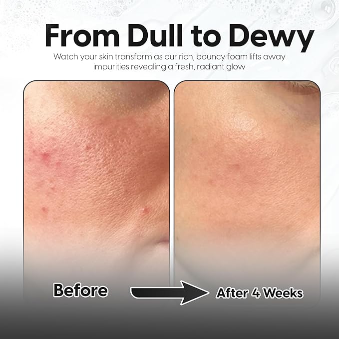 5% Lactic Acid + 2% Salicylic Acid Cleanser –Non-Stripping AHA/BHA Exfoliating Face & Body Wash With Ceramides. Minimizes Pores, Keratosis Pilaris, Acne, Ingrown Hairs & Psoriasis-200ml.-Velvo Beauty
