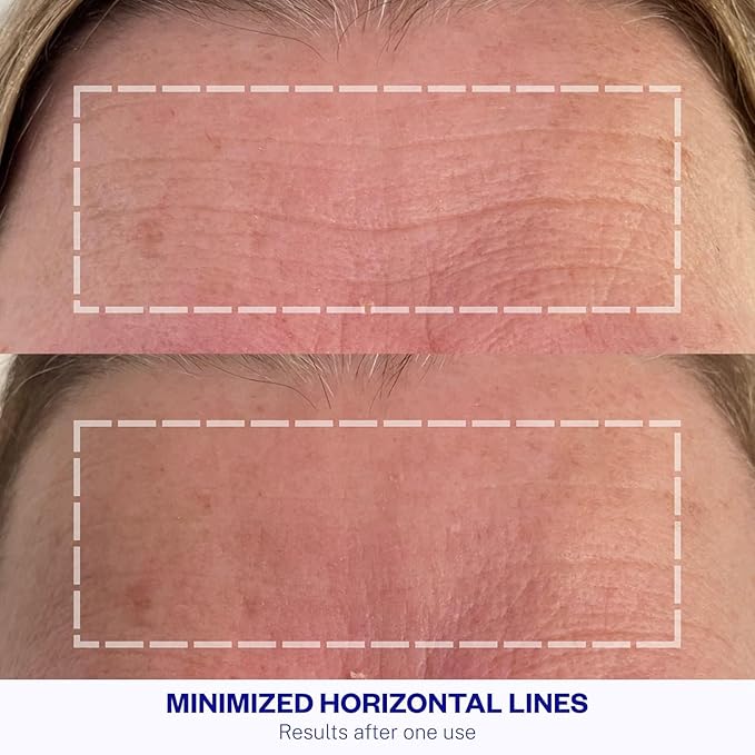 Wrinkles Schminkles Forehead Wrinkle Patches, 1-Pack, Reusable Hypoallergenic Silicone Smoothing Pads for Reducing Frown Lines & Face Lift Overnight-Velvo Beauty