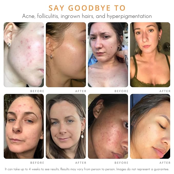 Face & Body Clearing Serum, Level 1- for acne, folliculitis, aging skin, ingrown hairs, dark spots - face, chest, butt, back, thighs, arms - mandelic acid - 1 fl oz-Velvo Beauty