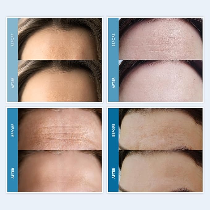Dersie Silicone Forehead Wrinkle Patches: Reusable Anti Wrinkle Pads for Wrinkles - Overnight Use Forehead Wrinkles Treatment (3 Count (Pack of 1))-Velvo Beauty