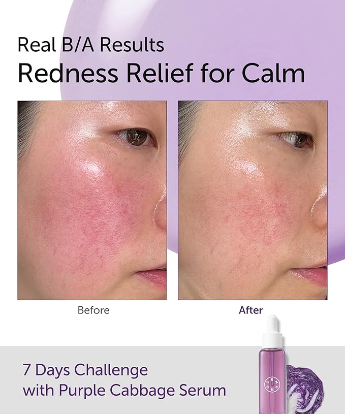 SERUMKIND Purple Cabbage Serum - Calming and Skin Recovery- Korean Face Skincare – Beta Glucan 100,000ppm – Soothing & Redness Relief - Vegan, Cruelty-Free – 1.01 fl.oz.-Velvo Beauty
