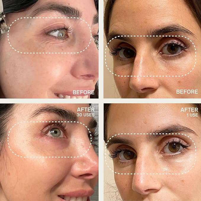 Dermaclara Face Patches Kit - Anti Wrinkle Patches for Forehead, Smile Lines, Silicone Anti-Wrinkle Frown Line Treatment, Up to 30 Uses - 1 Forehead, 2 Mouth, 2 Eye, 1 Neck & 1 Patch Prep Cleanser-Velvo Beauty