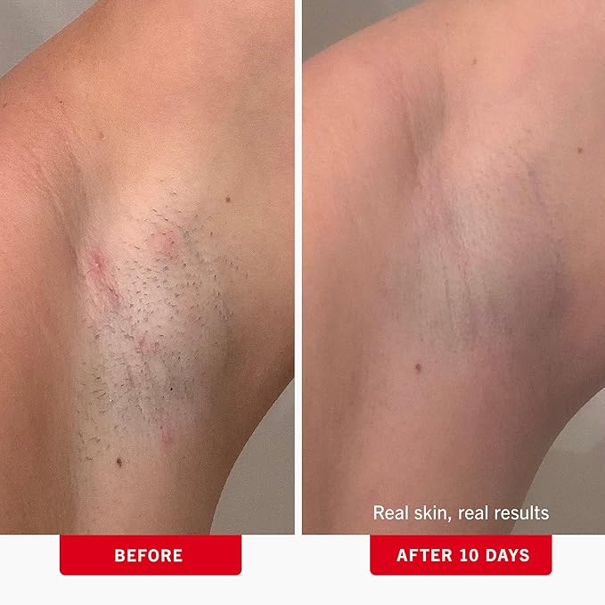 First Aid Beauty - Ingrown Hair Pads with BHA + AHA - Aftershave Treatment Pads Help Men & Women Prevent Razor Bumps, Exfoliate Underarms & Bikini Area, Compostable for Daily Use - 3ct, 84 Pads Total-Velvo Beauty