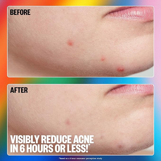 PEACE OUT Acne Healing Pride Dots Helps Clear Blemishes Overnight, Fast Acting Hydrocolloid Pimple Patches for Breakouts with Salicylic Acid, Retinol and Aloe Vera, Award Winning Skincare 16 Count-Velvo Beauty