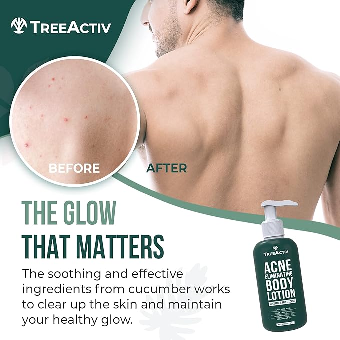 TreeActiv Acne Eliminating Body Lotion 8 fl oz | Clears Body, Back, Butt and Shoulder Acne | Anti-Acne Moisturizer | Prevents Future Breakouts | Cucumber Mint Scent-Velvo Beauty