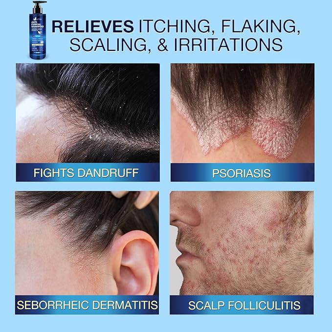 Anti-Fungal Shampoo for Scalp Psoriasis: Dandruff Shampoo for Folliculitis and Seborrheic Dermatitis - Relieves Itchy & Dry Scalp - 300 mL / 10.1 fl.oz-Velvo Beauty
