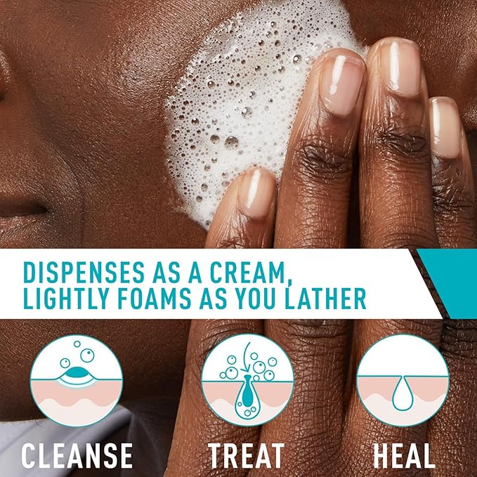 CeraVe Acne Foaming Cream Cleanser, 4% Benzoyl Peroxide Face Wash With Hyaluronic Acid, Niacinamide & Ceramides, Gentle Daily Acne Treatment For Face-Velvo Beauty