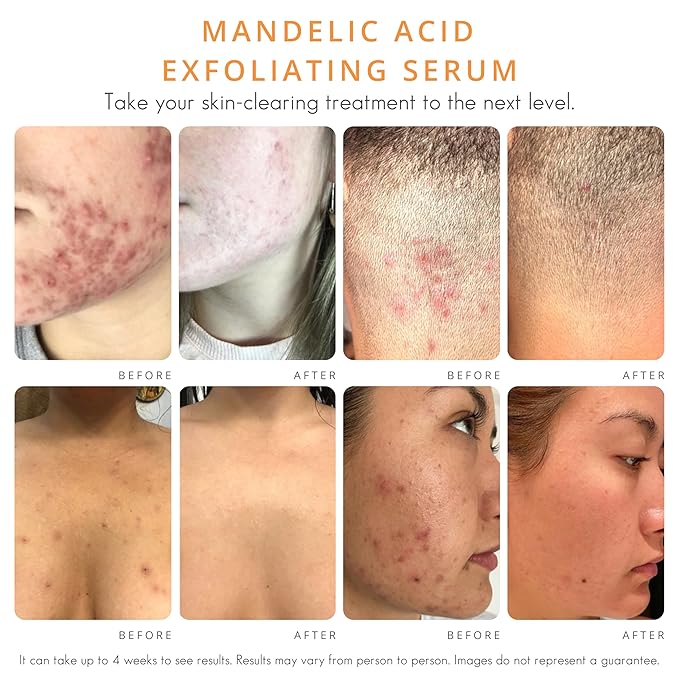 Face & Body Clearing Serum, Level 1- for acne, folliculitis, aging skin, ingrown hairs, dark spots - face, chest, butt, back, thighs, arms - mandelic acid - 1 fl oz-Velvo Beauty