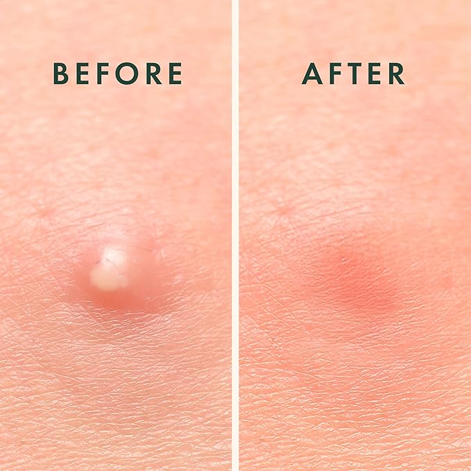 Rael Pimple Patches - Miracle Overnight Spot Cover, Thicker & Extra Adhesion, Hydrocolloid Acne Treatment for Face, Zits & Blemishes, Korean Skin Care, Vegan & Cruelty-Free, 3 Sizes (104 Count)-Velvo Beauty